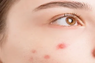 کفگیرک پوست علل، علائم، پیشگیری و درمان